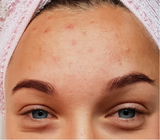 Before and after comparison of a person's eye area with and without treatment.